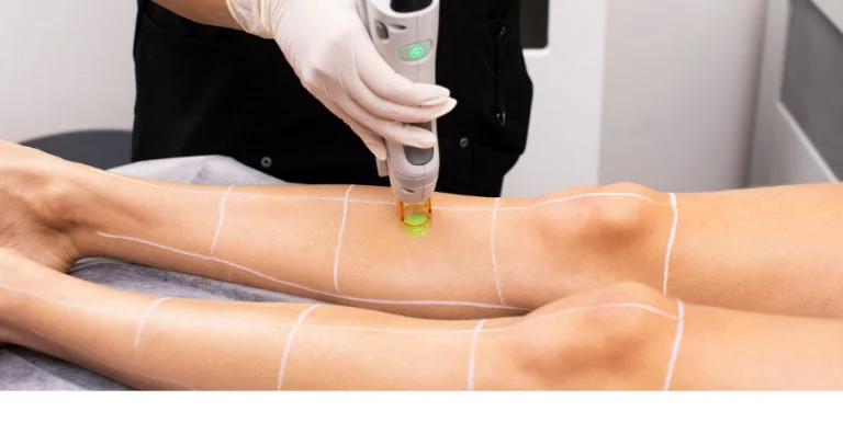 Is Laser Hair Removal Painful in London?